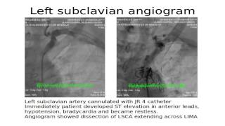 Left subclavian angiogram [upl. by Anil]