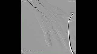 Heberdens nodes angiography [upl. by Koby]