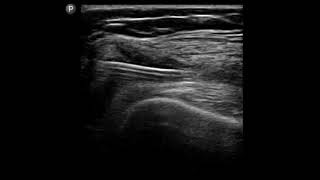 Knee Ultrasound Joint Injection at the Suptrapatellar Recess [upl. by Senaj]