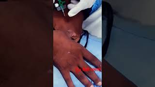 external jugular vein cannulation technique [upl. by Arac]