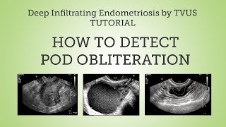 Pouch of Douglas Obliteration Detection by TVUS Tutorial [upl. by Bate]