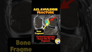 Fig 2B15 ACL Avulsion fracture from the femoral attachment [upl. by Euqina]