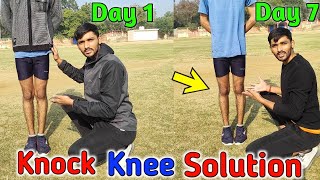 Knock knee कैसे ठीक करें  Knock knee problem solution  knock knees best exercise and tips in hindi [upl. by Klein]