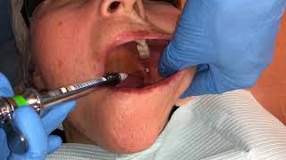 Inferior Alveolar and Lingual Nerve Blocks [upl. by Patricia]