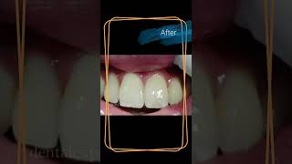 teeth gap  teeth gap filling  Composite filling [upl. by Japheth797]