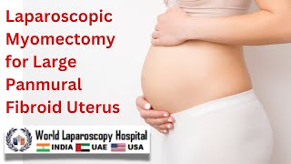 Laparoscopic Myomectomy for Large Panmural Fibroid Uterus An Ideal Surgical Approach [upl. by Olwen]