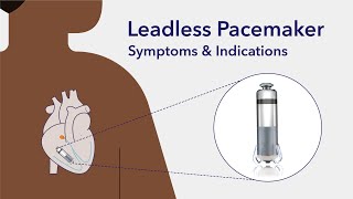 Transformative world of leadless pacemakers [upl. by Aldus]