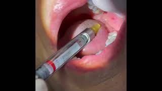 Dental Anaesthesia inferior alveolar nerve block [upl. by Ashley]