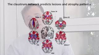 Localizing parkinsonism based on focal brain lesions [upl. by Elbam]