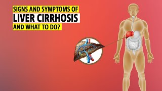 Signs and symptoms of Liver Cirrhosis and what to do [upl. by Wernsman121]