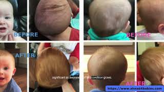 Infant Flat Head Treatment Helmet For Infant Head Shaping UK [upl. by Close454]