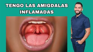 AMIGDALAS INFLAMADAS  QUE ES LA AMIGDALITIS  DR DAVID CAMPOS [upl. by Leoline930]