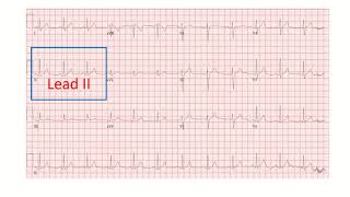 Corrected QT interval QTc on electrocardiogram part 2 [upl. by Valda]