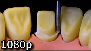 All Ceramic Crown Preparation For Upper Central Maxillary Incisor [upl. by Malet]