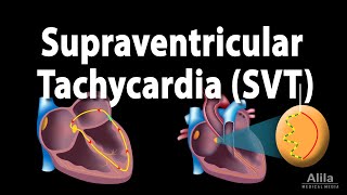 Supraventricular Tachycardia SVT PSVT Animation [upl. by Legin]