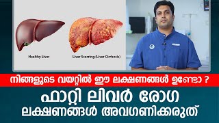 നിങ്ങളുടെ വയറ്റിൽ ഈ ലക്ഷണങ്ങൾ ഉണ്ടോ  Fatty Liver രോഗ ലക്ഷണങ്ങൾ അവഗണിക്കരുത് [upl. by Aeneus]