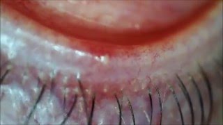 Pus filled Pimple INSIDE the eyelid [upl. by Idna918]