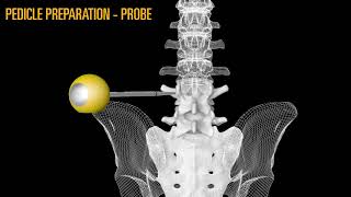 CoreLink Tiger Pedicle Screw System [upl. by Renado]