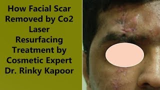 Co2 Laser Resurfacing Treatment for Facial Scars  The Esthetic Clinics India [upl. by Jabe962]