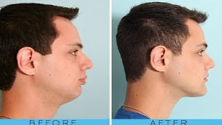 how to get rid of chubby cheeks and get a good jawline [upl. by Nwadal]