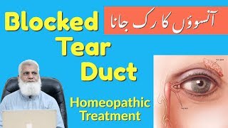 Tear Duct Blockage Homeopathic Medicine  Clogged Lacrimal Sac  Dacryocystitis Treatment [upl. by Lecrad]