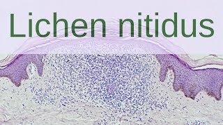 Lichen Nitidus  Pathology mini tutorials [upl. by Ahsinauj]