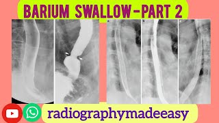 BARIUM SWALLOW Part 2  Contraindications  Patient Preparation  Procedure [upl. by Suolekcin488]