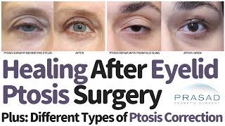 Different Types of Eyelid Ptosis Surgical Correction Techniques and Expected Healing Time [upl. by Silloh]