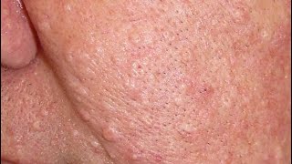 Sebaceous hyperplasia removal [upl. by Vaules]