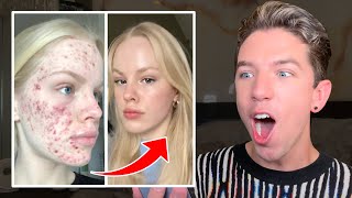 Reacting to MindBlowing Skin Transformations😱 [upl. by Yennej]