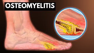 Osteomyelitis What You Need To know [upl. by Lambertson660]