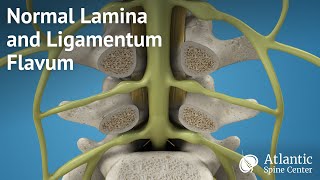 Normal Lamina and Ligamentum Flavum [upl. by Fisch146]