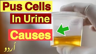 Puss cells in urine  Causes of pus cells in urine [upl. by Haneehs583]