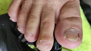 Toenail Ingrown Removal makapal na ang dryskin [upl. by Aicinoid827]