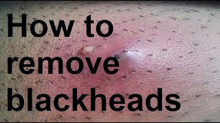 How to remove blackheads [upl. by Mariand]