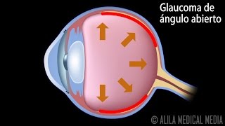 Glaucoma de Ángulo Abierto y de Ángulo Cerrado Animación Alila Medical Media Español [upl. by Erdnaed]