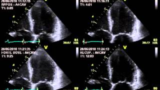 TRUE SEVERE AORTIC STENOSIS  STRESS ECHOCARDIOGRAPHY cardiac ultrasound [upl. by Neerom]