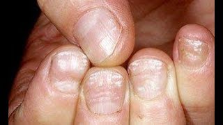 White Stains or White Marks on your Toenails Home Treatment Guide [upl. by Tice129]