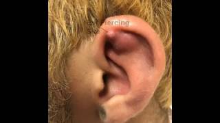 Left Ear Helix Abscess Chondritis or Not [upl. by Akeim]