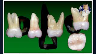 Módulo I  Aula 3 Cirurgia de Acesso  Molares Superiores [upl. by Acirfa]