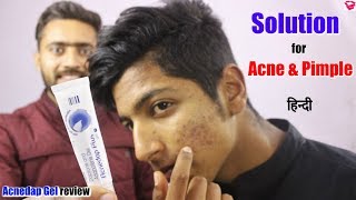 Best gel for Acne and Pimples  Effect Results How to use  Acnedap plus gel review [upl. by Otir896]