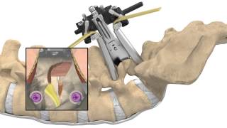 MAS® TLIF Patient Animation [upl. by Nylidnam885]