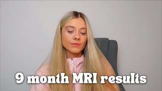 brain cancer update MRI results clinical trial and where my tumour is [upl. by Doehne]