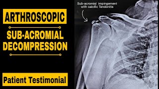 ARTHROSCOPIC SUBACROMIAL DECOMPRESSION PATIENT TESTIMONIAL [upl. by Glanti570]