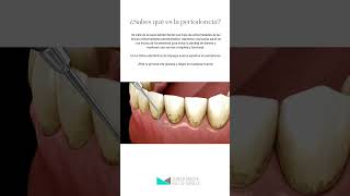 ¿Sabes qué es la periodoncia [upl. by Lander412]