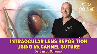 Intraocular Lens Reposition Using McCannel Suture WATCH SURGERY [upl. by Aible]