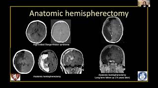 Imaging of hemispheric disconections S Prabhu [upl. by Rotce976]