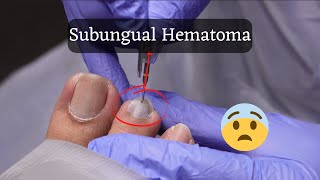 Hematoma Causes Signs and Symptoms Diagnosis and Treatment [upl. by Achorn]