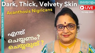 Acanthosis Nigricans  കറുത്ത നിറംപാടുകൾ  എന്തിനെ സൂചിപ്പിക്കുന്നു  മാറിപോകാൻ ചെയ്യേണ്ടത് [upl. by Jolynn]