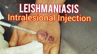 Leishmaniasis Treatment [upl. by Lennie]